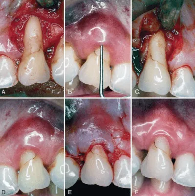 Абсцесс зуба: что это такое - симптомы и лечение | Стоматологическая  клиника «Дентал Эффект»