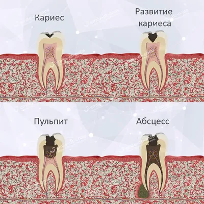 Абсцесс зуба. Причины заболевания, лечение и профилактика