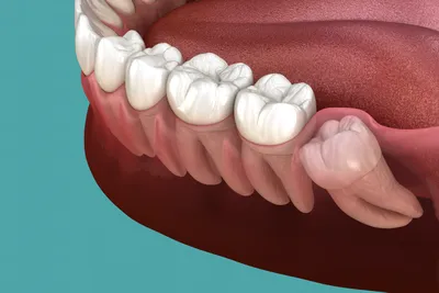 Абсцесс зуба: методы диагностики, профилактики и способы лечения