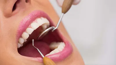 Абсцесс зуба: что это такое - симптомы и лечение | Стоматологическая  клиника «Дентал Эффект»
