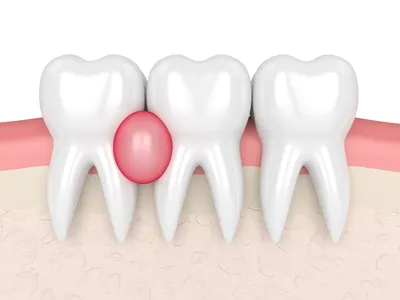 Абсцесс зуба: что это, как лечить, симптомы и причины
