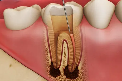 Лечение воспаления зубного корня, признаки и сиптомы воспаления корня зуба  под коронкой