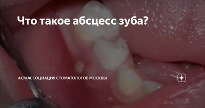 Абсцесс зуба [причины, симптомы, удаление и лечение в Москве]