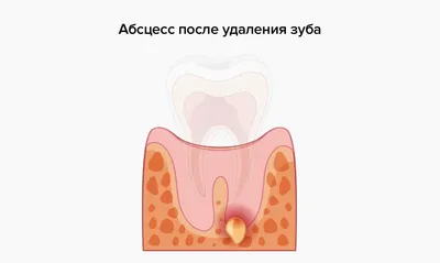 Воспаление корня зуба: ✔️лечение ✔️этапы ✔️профилактика | Denten.by