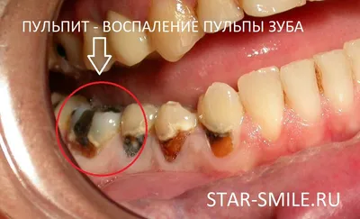 Флюс после удаления зуба мудрости — чем полоскать и сколько проходит в  статье Startsmile