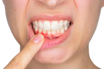 Причины воспаления пульпы зуба. Симптомы и причины возникновения пульпита