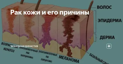 Рак кожи: плоскоклеточный, базальноклеточный, меланома - диагностика и  лечение в Москве