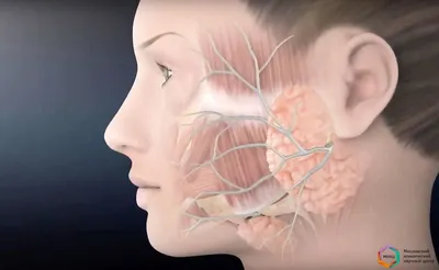 Аденосквамозная карцинома | MyPathologyReport.ca