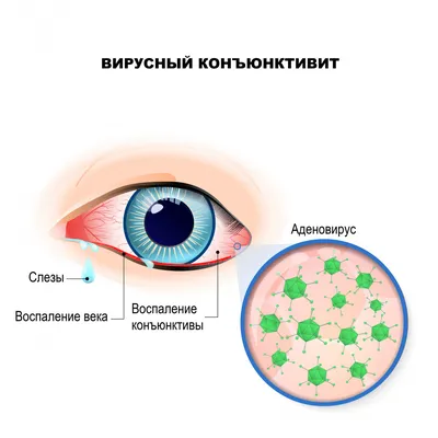 Аденовирусная инфекция глаз фото фото