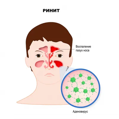 Аденовирусная инфекция: как малыш может заразиться, чем опасна эта болезнь,  можно ли лечиться дома? | О детском здоровье: с врачебного на родительский  | Дзен