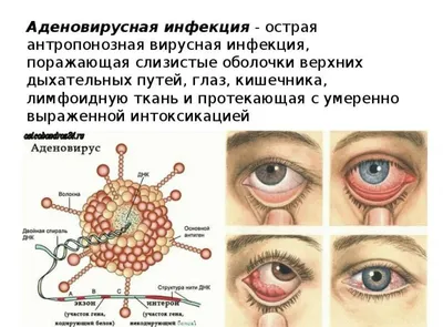 Аденовирусная инфекция у детей: конъюнктивит, насморк и не только | О  детском здоровье: с врачебного на родительский | Дзен