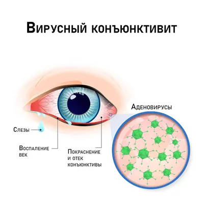 Аденовирусная инфекция у детей: конъюнктивит, насморк и не только | О  детском здоровье: с врачебного на родительский | Дзен