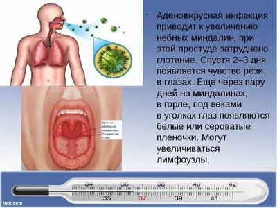 Аденовирусная инфекция у детей: конъюнктивит, насморк и не только | О  детском здоровье: с врачебного на родительский | Дзен