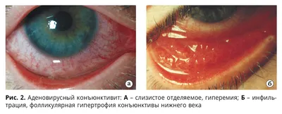 Конъюнктивиты: дифференциальная диагностика и лечение - Издательство АПРЕЛЬ