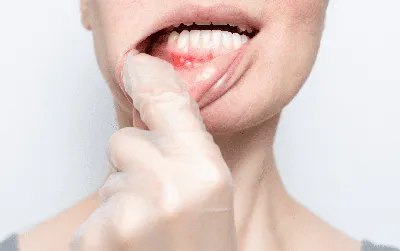 Афтозный стоматит: причины, симптомы, диагностика и лечение хронического  стоматита у стоматолога