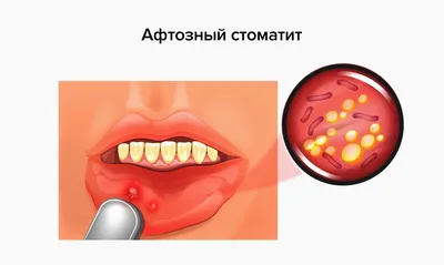 Стоматит: Лечение стоматита у взрослых – симптомы, признаки | CIS