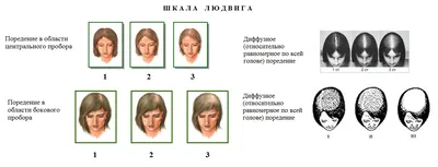Андрогенетическая алопеция у женщин - Charismo Russia