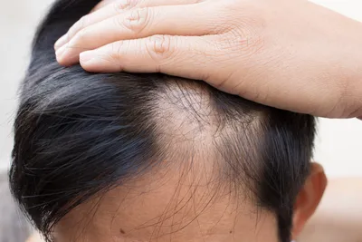 Почему выпадают волосы при андрогенной алопеции: отзывы и мнения  специалистов📌 - статьи экспертов Селенцин