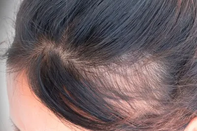 hairHelp - Имеем дело с АГА у женщины. Поредение волос по типу  рождественский елки, 2 стадия на фоне Диффузной медикаментозно  индуцированной алопеции (приём цитостатиков). Назначено комплексное  лечение: -препараты внутрь -наружная терапия -правильный