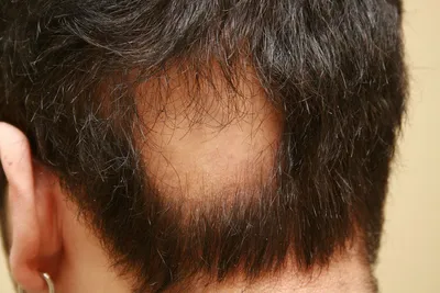 Хроническое выпадение волос (АГА). Часть 2 - 8 Июня 2013 - БЛОГ - Все о  здоровье волос