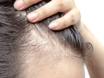 Какие гормоны роста волос на голове у женщин влияют на облысение?📌 -  статьи экспертов Селенцин