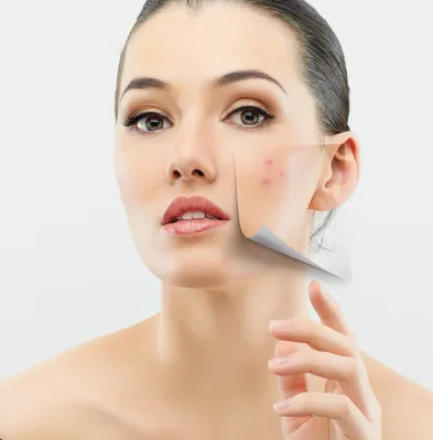 Чем снять воспаление акне на лице: домашние способы и медикаменты | ЛЕМАРК