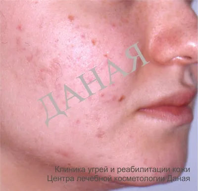 Акне (аcne vulgaris), или угри - хроническое рецидивирующее воспалительное  заболевание кожи, когда появляются чёрные.. | ВКонтакте