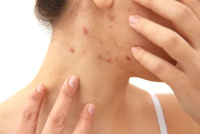Лечение акне Акне является самым распространенным заболеванием кожи.  Существует несколько причин из-за которых развивается акне, и чем… |  Instagram