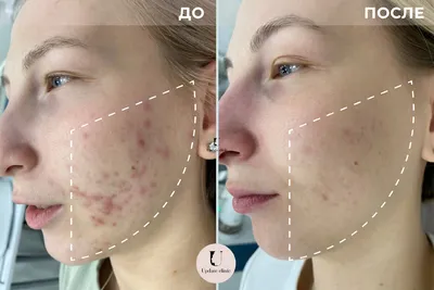 Лечение акне: до и после | Косметолог Елена Умнова | Дзен