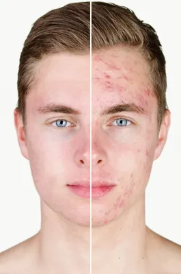 Прыщи на лице: причины и эффективные меры лечения и профилактики | Здоровье  | WB Guru