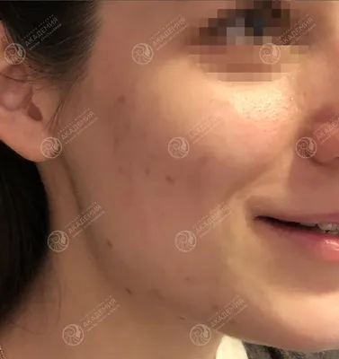 Как и чем лечить угревую сыпь на лице: причины и лечение высыпаний на лице