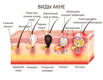 Инверсное акне: причины, симптомы, лечение