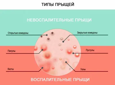 Лечение акне - Эпимед