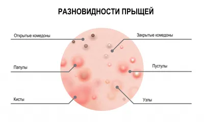 Акне лечение консультация в Санкт-Петербурге в медицинском центре ID-CLINIC