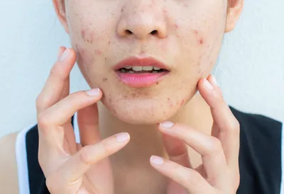 Как замаскировать прыщи при помощи макияжа | Косметолог Елена Умнова | Дзен