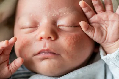 Сыпь у новорожденных: опасные и безопасные высыпания, милии, акне, меланоз  и дерматит