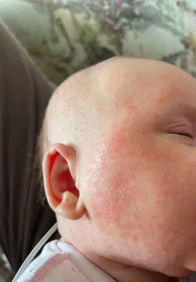 Клиника «Здоровые Дети» on Instagram: \"Акне новорожденных —  распространенная проблема кожи новорожденных, которая может возникнуть в  первые три месяца жизни. Акне проявляется в виде красных прыщиков на лице,  особенно на щеках, лбу,