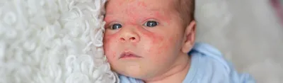 Акне у младенцев: как отличить от аллергии? - Sancos in Chisinau