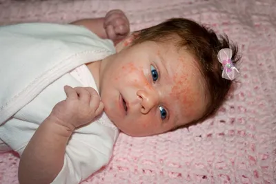 Акне новорождённых или аллергия? — 20 ответов | форум Babyblog