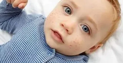 закрывание кожицы лица младенца прыщами и акне от дерматита. Стоковое Фото  - изображение насчитывающей медицинско, малыш: 256904928