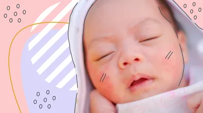 Сыпь на лице у новорождённого. | Педиатр Юлия Ступакова ВОРОНЕЖ | Дзен
