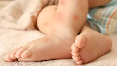 Высыпания у ребенка на коже. Виды, диагностика и лечение