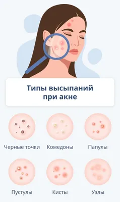 Акне на лице: причины и методы лечения в Москве