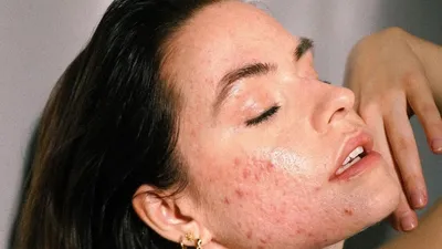Акне Майорка: сыпь на лице и теле после отпуска