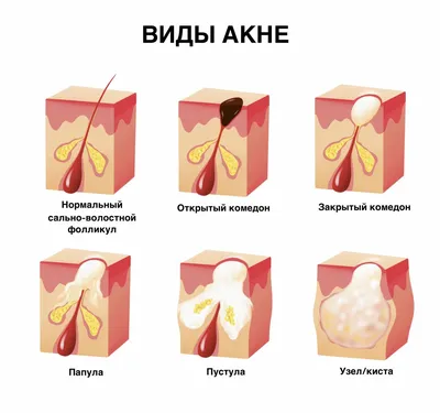 Как вылечить акне - лучшие процедуры