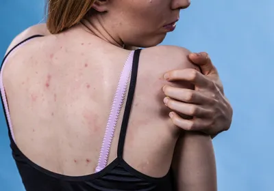 Сыворотка Jaysuing для лечения акне на спине и груди, 120 мл | AliExpress