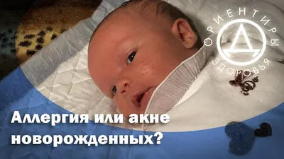 Так ли страшно акне новорожденных? Нужно лечить акне? | Дитячий медичний  центр Ліни Барської