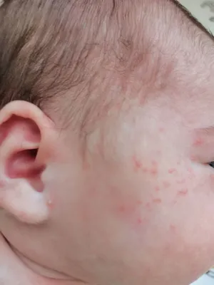 Аллергия или акне новорожденных? - YouTube