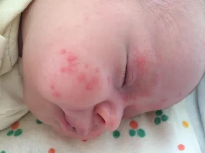 Это ведь акне новорожденных? Или все же аллергия? Такое только на щёчк...