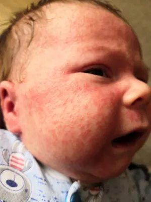 Акне новорожденных или аллергия - Вопрос дерматологу - 03 Онлайн